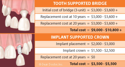 cost teeth implants usa
