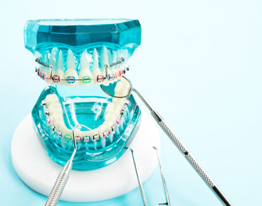 Braces- treatment at Mooresville dental care 