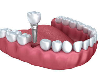 Will Dental Implants really help you? Let’s see what the Clinical results say?- treatment at Mooresville dental care 