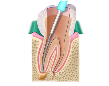Root Canals: FAQs about treatment that can save your Tooth