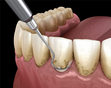 Everything you Need to Know About Scaling and Root Planing- treatment at Mooresville dental care 