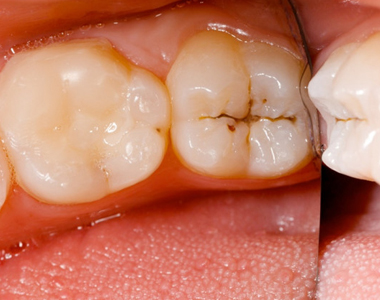 How to Assess Your Risk for Tooth Decay- treatment at Mooresville dental care 