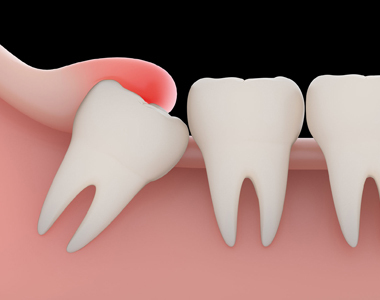 Problems with a Wisdom tooth and when you need to remove them- treatment at Mooresville dental care 