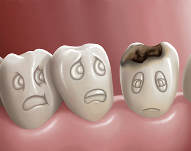 Cavities, or tooth decay- treatment at Mooresville dental care 