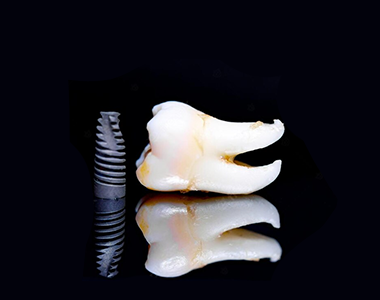 Zygomatic implants- treatment at Mooresville dental care 