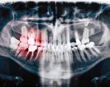 Dental x-ray- treatment at Mooresville dental care 