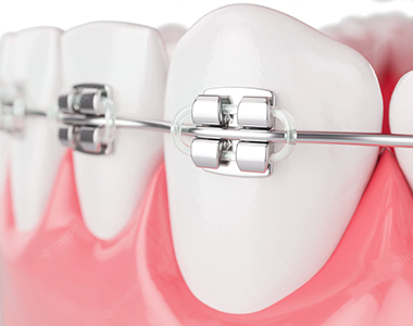 Braces- treatment at Mooresville dental care 